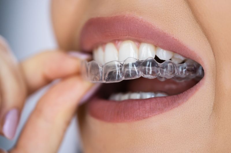 Aligner treatment in Satellite Ahmedabad 