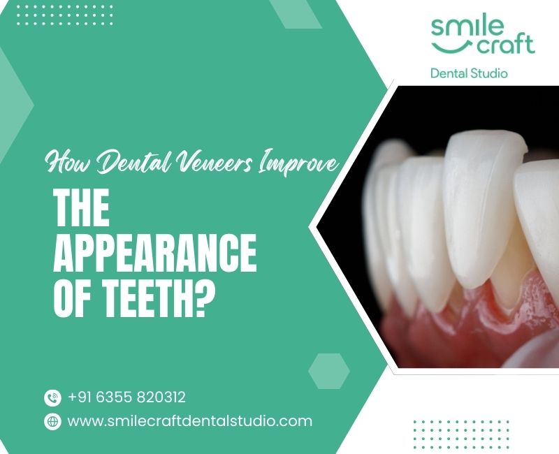 How Dental Veneers Improve the Appearance of Teeth?